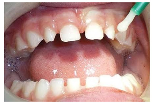 Flouride Aplication For Caries Prevention